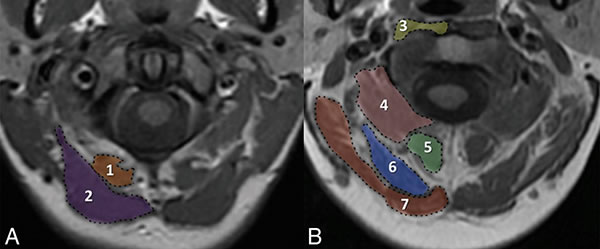 Magnetic resonance imaging of the suboccipital (suboccipital) muscles. Muscles at the level of the anterior arch of the C1 vertebra (A): 1 - the small posterior rectus muscle of the head, 2 - the large posterior rectus muscle of the head. Muscles at the level of the middle of the odontoid process of the C2 vertebra (B): 3 - longus muscle of the neck/head, 4 - lower oblique muscle of the head, 5 - semispinal muscle of the neck, 6 - semispinal muscle of the head, 7 - belt muscle of the head.